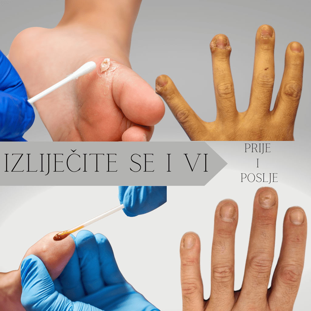 Na slici je opisano lijecenje kurije oci i bradavice