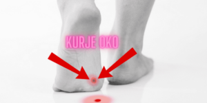 Read more about the article Kurje oko na nozi – Nevjerovatno Upozorenje za 2025