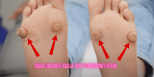 Read more about the article Kako Ukloniti Kurje Oko Prirodnim Putem: Savjeti za 2025g.
