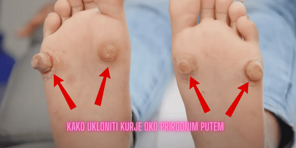 Kako Ukloniti Kurje Oko Prirodnim Putem
