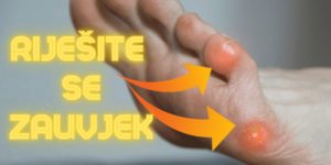 Lijek za Kurje oko (Kurije oči)
