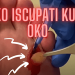KAKO ISČUPATI KURJE OKO: 5 Moćnih Savjeta za problem