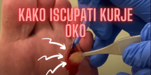Read more about the article KAKO ISČUPATI KURJE OKO: 5 Moćnih Savjeta za problem