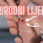 PRIRODNI LIJEK ZA KURJE OKO:Top 19 Recepata za ovaj problem